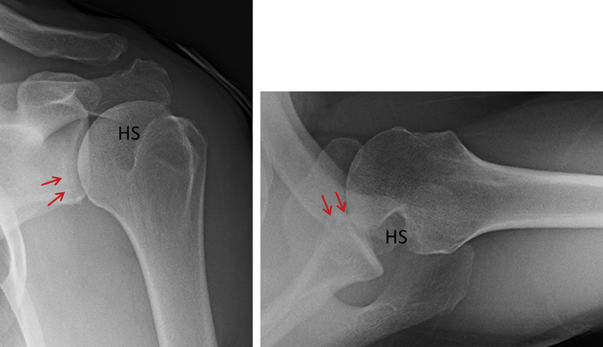 Fig 1. Anteroposterior and axillary x-rays of left shoulder showing. 