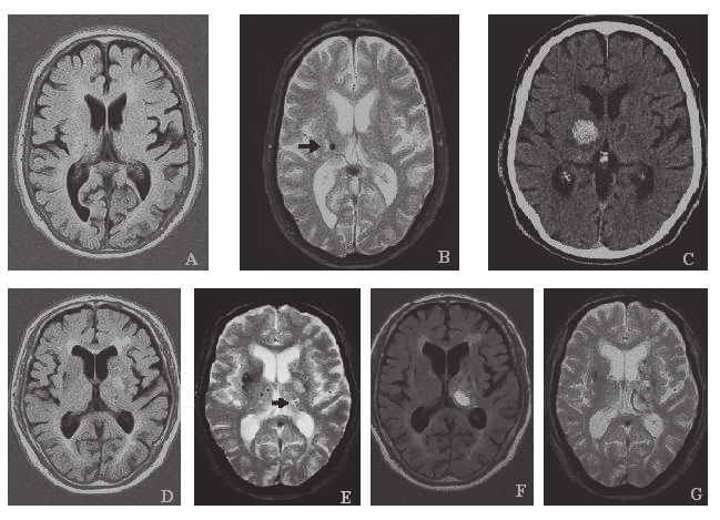 1 Brain MR (FLAIR and T2*-weighted images) of patient A showing a ...