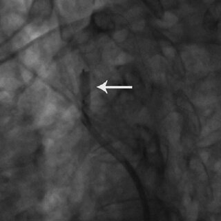 angiogram cordis stent ostial
