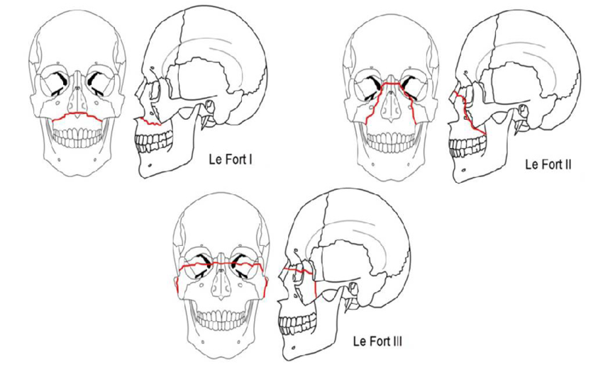 Le fort. Лефор переломы верхней челюсти. Лефор классификация переломов верхней челюсти.