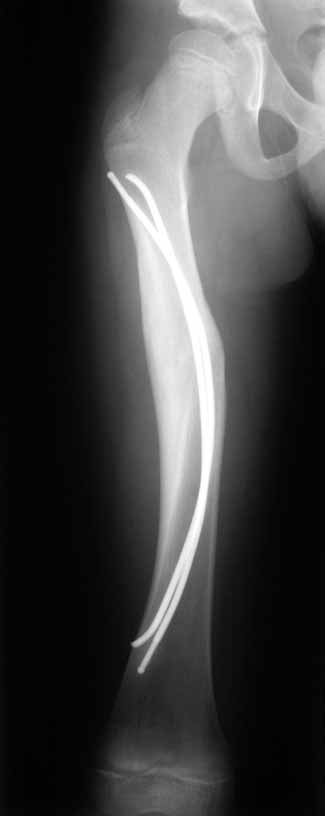 Radiograph Showing Good Union Of A Proximal Diaphyseal Fracture At 10