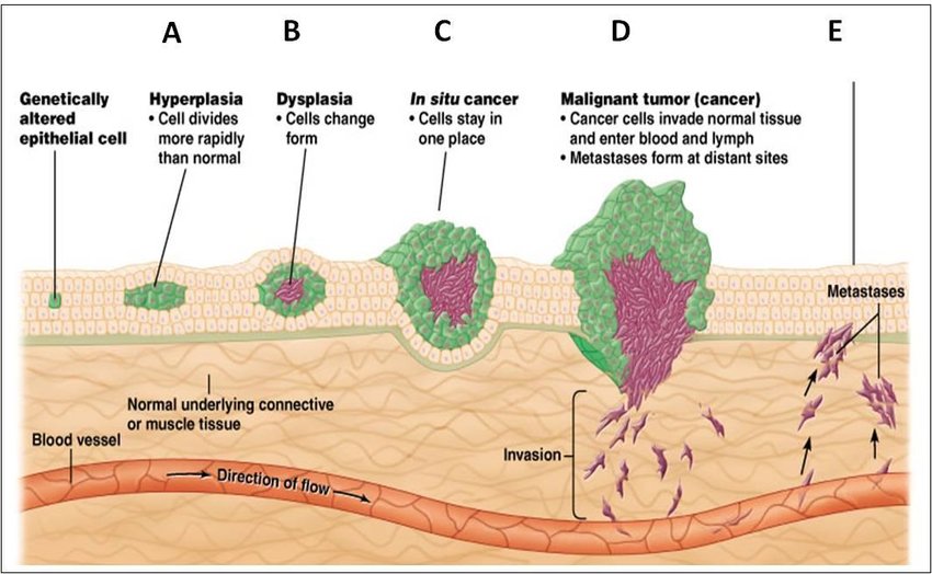 Stages of tumor development and mechanism of metastasis