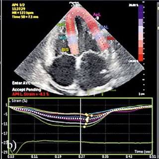 a) Tissue Doppler Imaging evaluation of the LV lateral wall showing... | Download Scientific Diagram