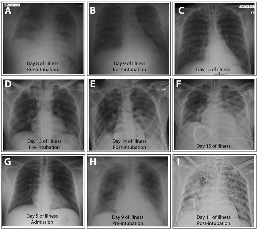 Chest radiographs of patients with Ebola virus disease obtained during... | Download Scientific ...