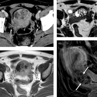 A 48-year-old woman with adenoma malignum in the uterine cervix with