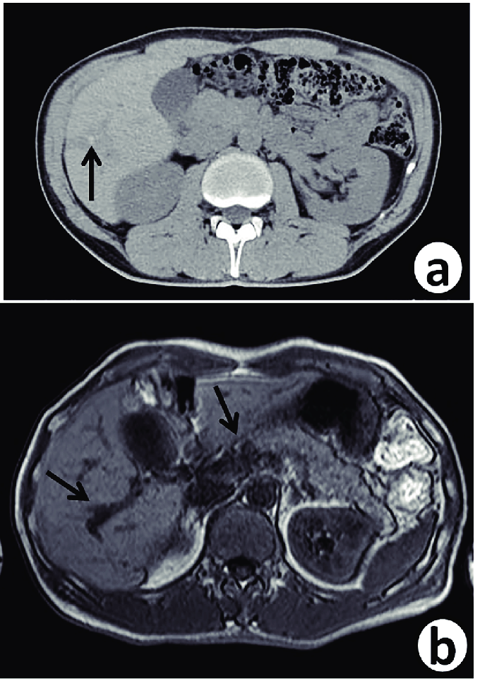 Follow Up Abdominal Contrast Enhanced Ct Scan A And Mri T2 B 7