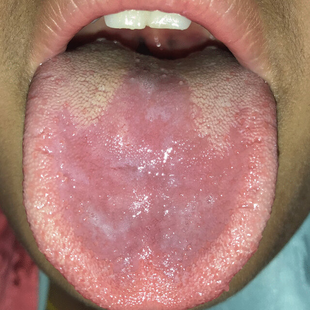 Fissured tongue (lingua plicata) | Download Scientific Diagram