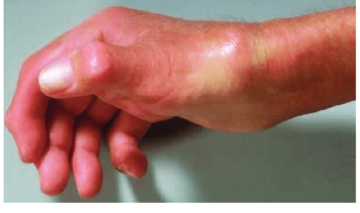 severe-systemic-sclerosis-of-hands-with-progressive-contractures-in-the-download-scientific