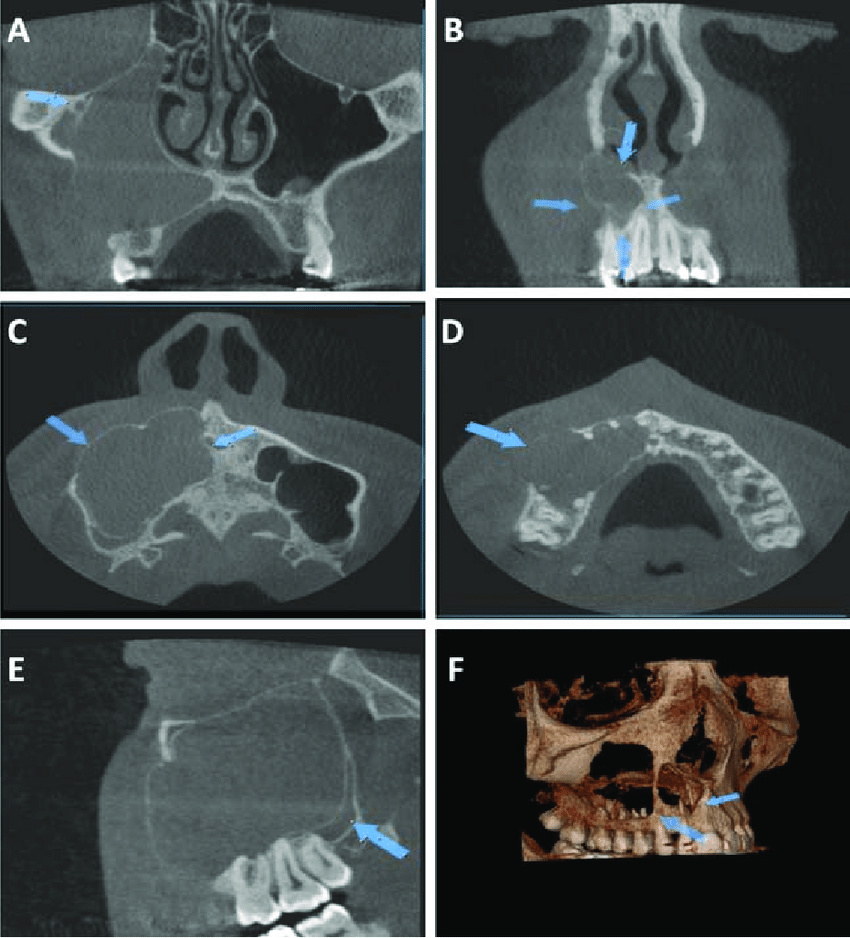 Cone Beam Computed Tomography Cbct Scans Of The Radicular Cyst In The