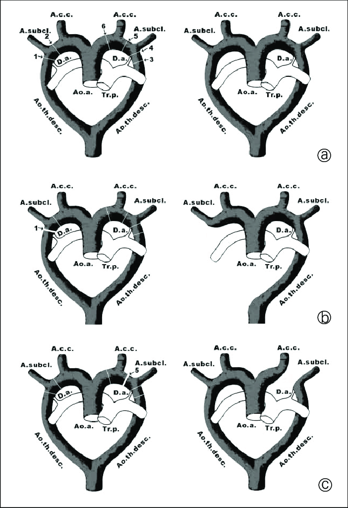 Abbildung 7a C Schematische Darstellung Der Aortenbogenmissbildungen Download Scientific Diagram