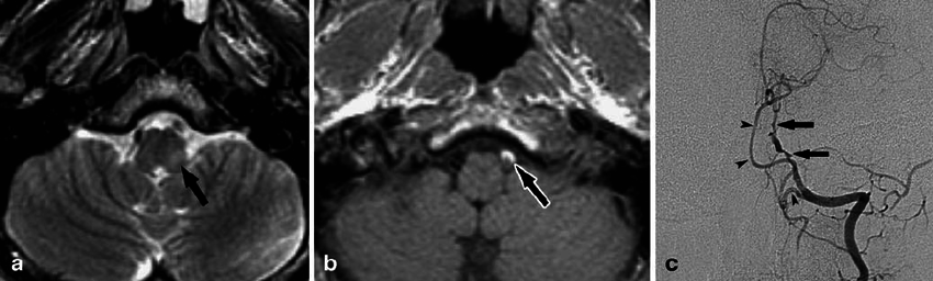 Images from a 38-year-old man with left-sided facial pain, vertigo, and ...