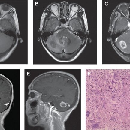 Pdf Cerebellar Cryptococcosis Characterized By A Space Occupying
