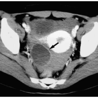 A 19-year-old woman with severe pelvic pain and a negative pregnancy