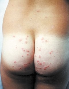 Erythematous and itchy papules in area covered by the swimsuit