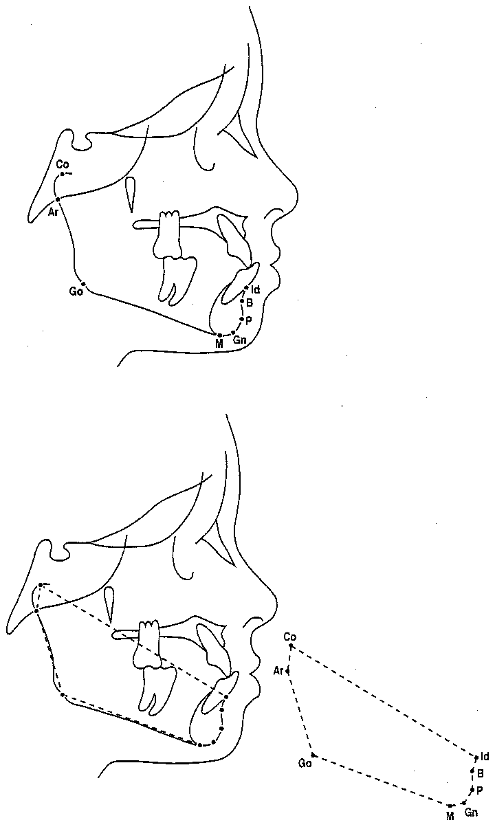 Figure 5 from Retrognathic maxilla in Habsburg jaw