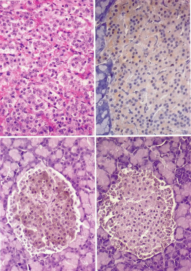 Pancreatic islet cell tumor