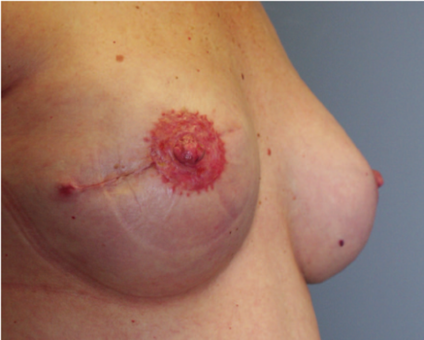 A 41-year-old woman presented with invasive breast car- cinoma of