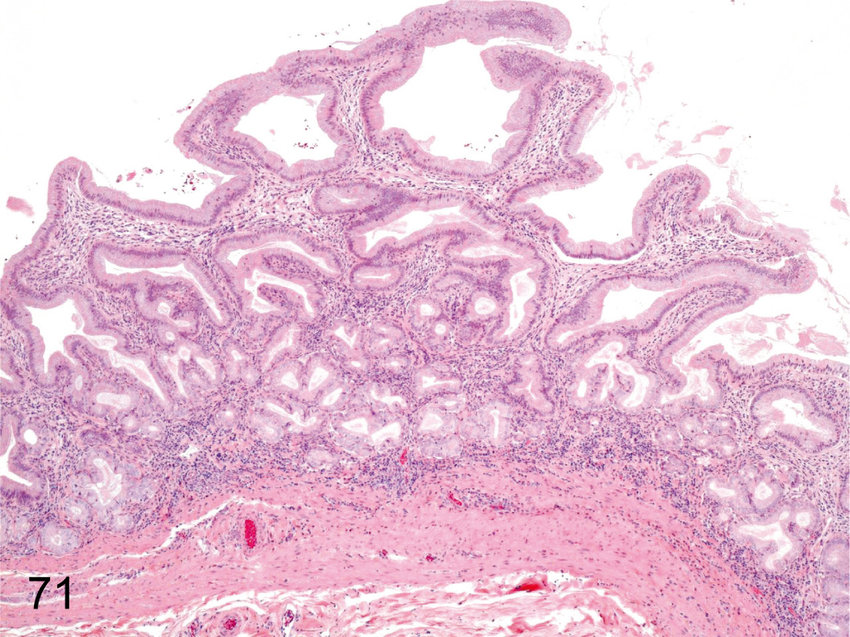 Gall Bladder Hyperplasia Of The Mucosal Epithelium Hyperplasia Of The ...