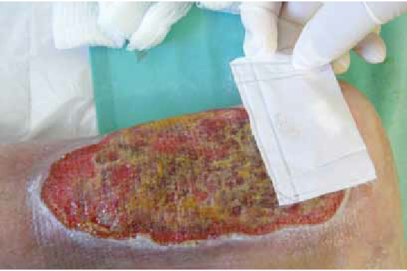 Caged application of maggots to a chronic wound. The maggots were caged