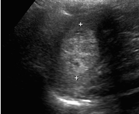 Splenic Hemangioma Ultrasound