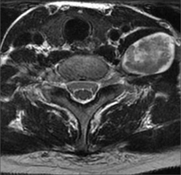 Axial T2 Weighted Fse Image Showing A Large Schwannoma Arising From The