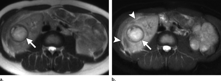Renal Abscess In A Thin 27 Year Old Woman A Axial T2 Weighted Mr