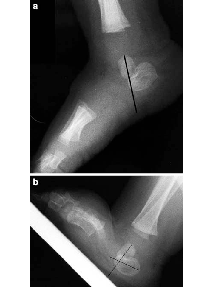 a Plantar flexion lateral radiograph of the right foot of a 12