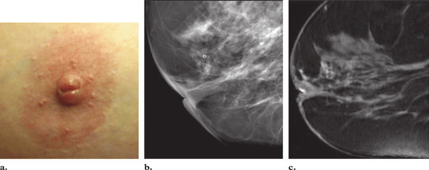 a) Photograph of a woman's breast shows slitlike retraction of the