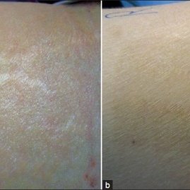 Fractional Co2 Laser As An Effective Modality In Treatment Of Striae Alba In Skin Types Iii And Iv Request Pdf