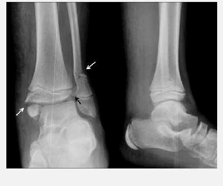 fractured ankle x ray
