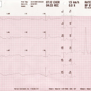Pdf Sixty Seconds Of Asystole After Exercise In A Healthy Person