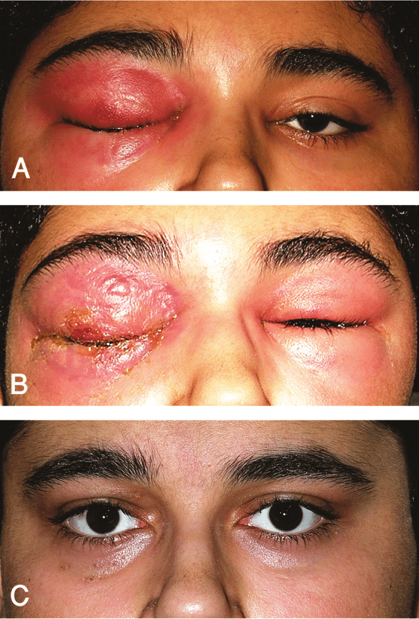 The patient had features of right periorbital cellulitis upon admission (A). One day