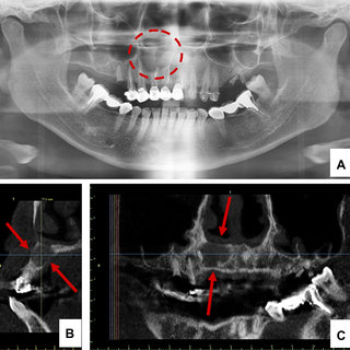 (A) Panoramic radiographic examination revealed incomplete root canal