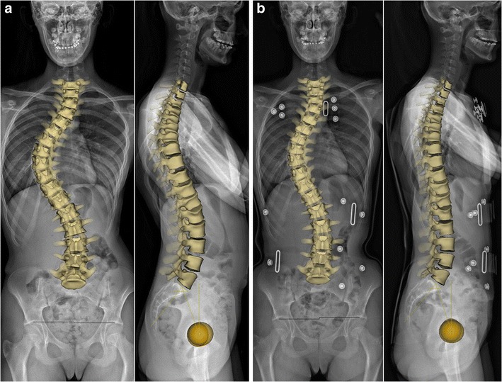 Surface 3D reconstructions of the spine without and with bracing