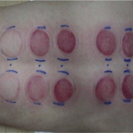 Cupping Marks Chart