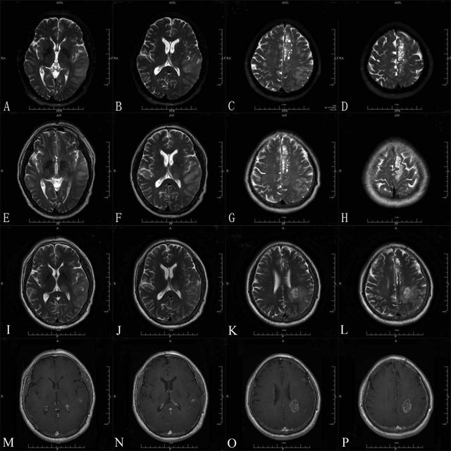 (AÀD). Initial brain MRI showed high T2 signal change affecting the ...