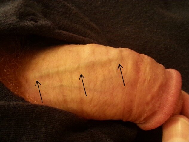 Dorsal veins of penis