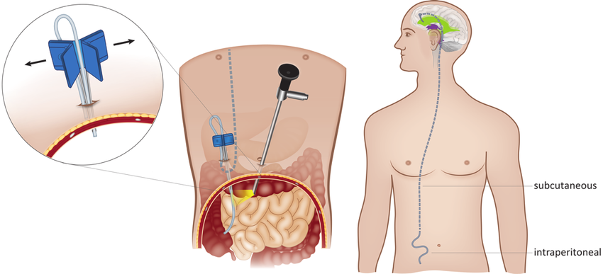 Artist's illustration of laparoscopic VP shunt placement. A 5-mm optic