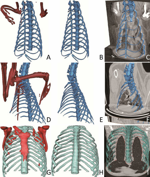 3-D Segmentation results on small animals (A-F) and human subject