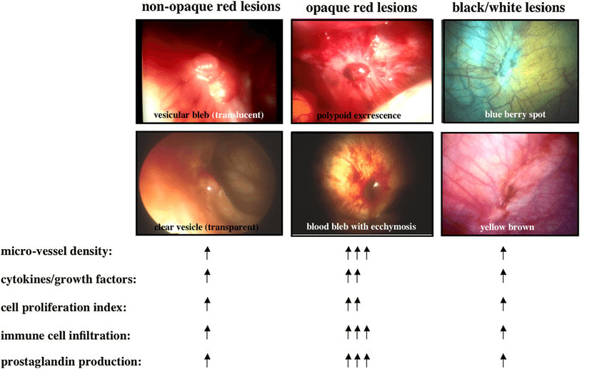 Morphological appearance of blood-filled opaque red lesions