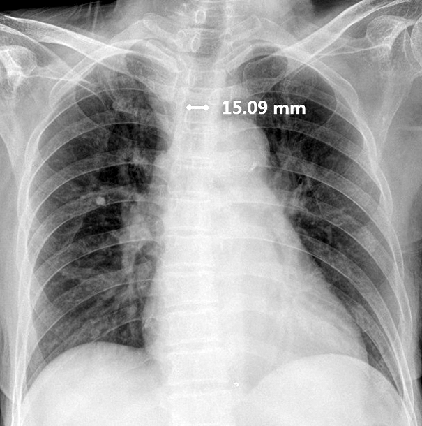Chest Xray findings. (A) On 1 st day of endotracheal