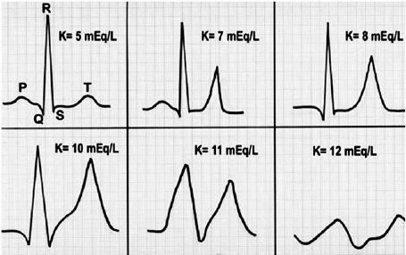 Electrocardiographic Findings In Hyperkalemia The Profiles Are