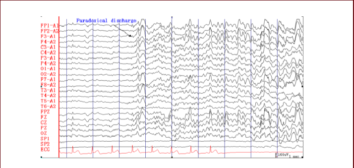 Electroencephalogram (EEG) and electrocardiogram (ECG) prior to ...