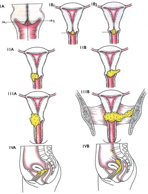 Staging of uterine cervix carcinoma according to FIGO (4). | Download  Scientific Diagram
