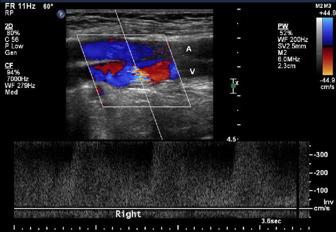 AV Fistula Ultrasound