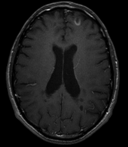 Axial T1-weighted with contrast image of a patient with MS demonstrate ...