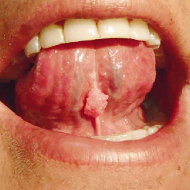 Virus papiloma en lengua - Inicio de papiloma en la boca, Inicio de papiloma en la boca