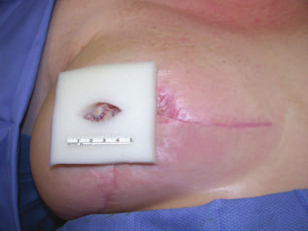 a reconstructed nipple with foam nipple guard in place.