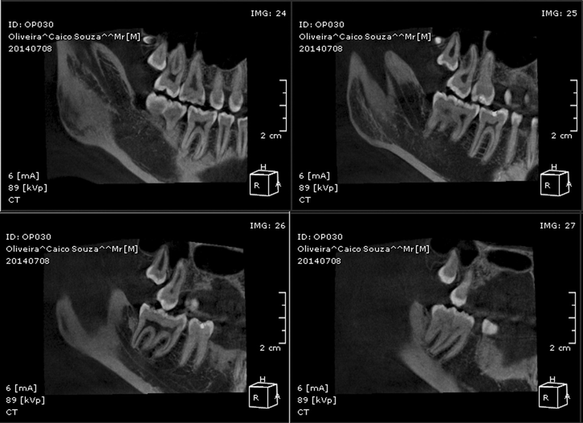 Ct Scan Performed On Cbct Op300instrumentarium Dental Sagittal