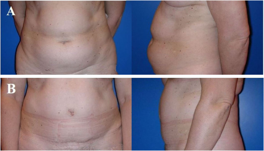 Donor site aesthetics and morbidity after DIEP flap breast